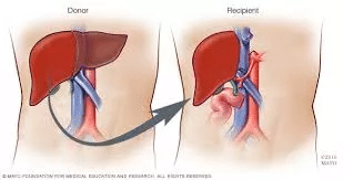 Best Hospitals for Liver Transplant in India