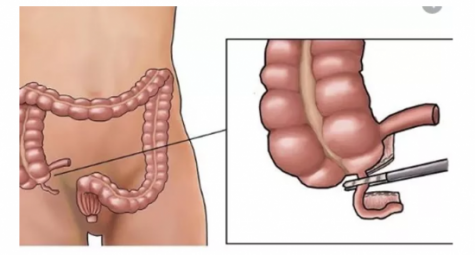 Appendectomy - Appendicitis