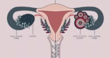 Polycystic Ovary Syndrome-(PCOS)