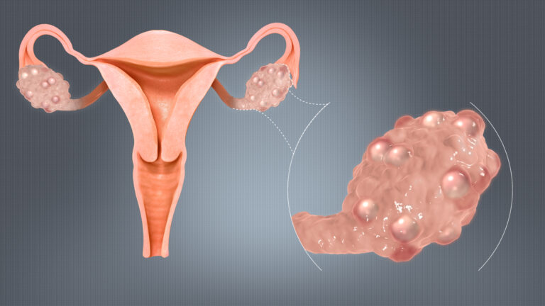 Polycystic ovarian syndrome (PCOS)