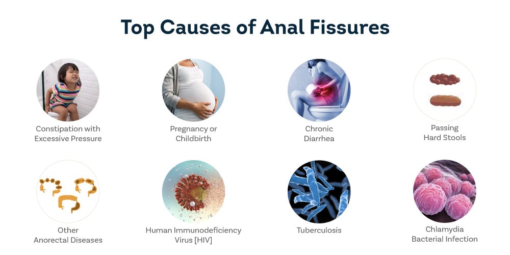 causes of anal fissure
