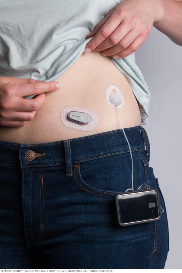 glucose monitors and insulin pump