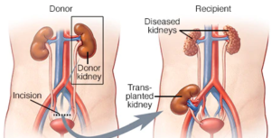 transplante de riñón