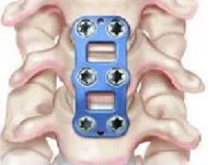 Anterior Cervical Discectomy With Fusion (ACDF)