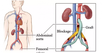 Aortofemoral (aortobifemoral) bypass surgery