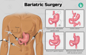 бариатиялык хирургия