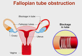 Blocked Fallopian Tube Treatment