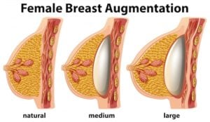 Cirugía de aumento mamario