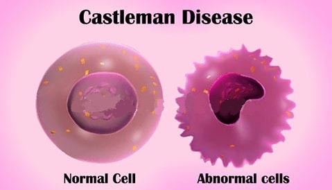 Tratamiento de la enfermedad de Castleman