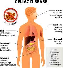 Celiac Disease Treatment