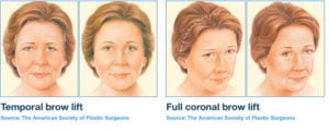 Koronare oder klassische Augenbrauenlifting-Operation