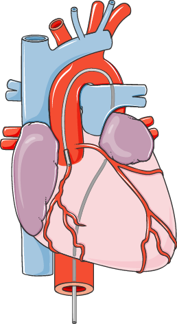 Herzkatheterisierung