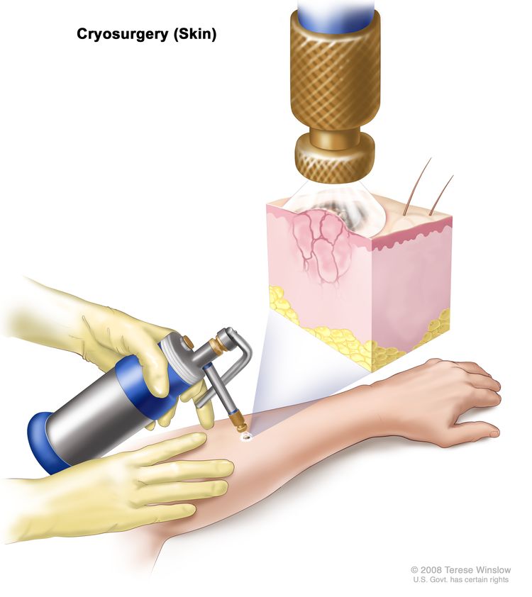 Cryosurgery for skin cancer