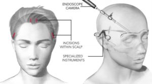 Endoskopische Augenbrauenlifting-Operation