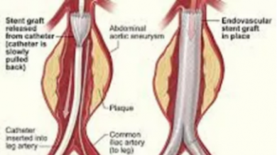 إصلاح تمدد الأوعية الدموية الأبهري (ترقيع دعامة الأبهر)
