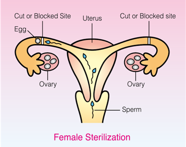 Sterilisation bei Frauen