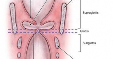Traitement de la sténose laryngée