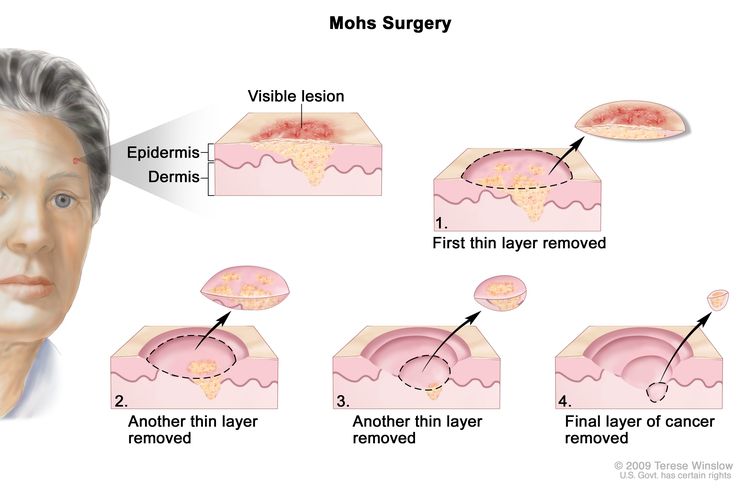 Mohs surgery