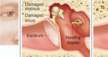 Ossciculoplastie-Chirurgie de l'oreille