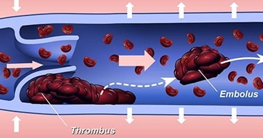 Venous ThromoboEmbolism (VTE) – DVT or PE