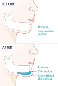 chin implant surgery before after