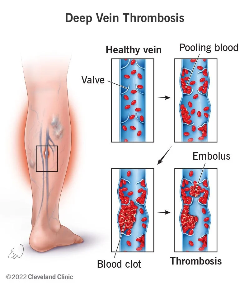 deep vein thrombosis dvt