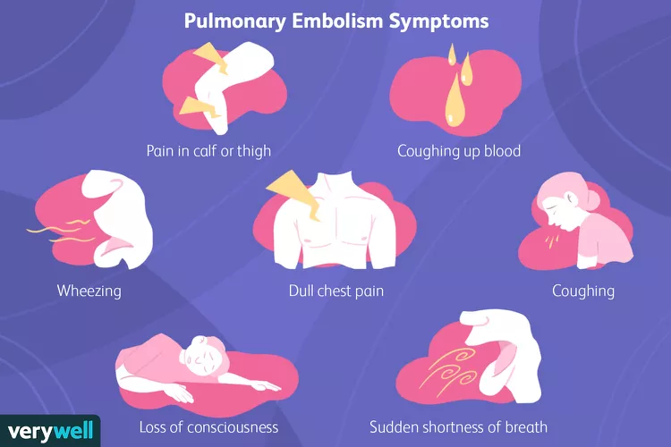 Pulmonary Embolism Symptoms 9 Signs And Symptoms Of Pe Healthella
