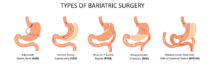 types of bariatric surgery procedures