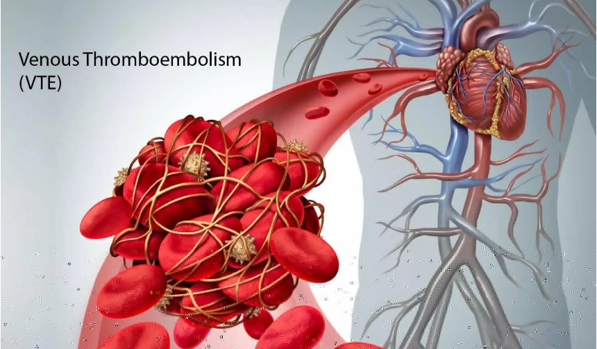 Tromboembolismo venoso