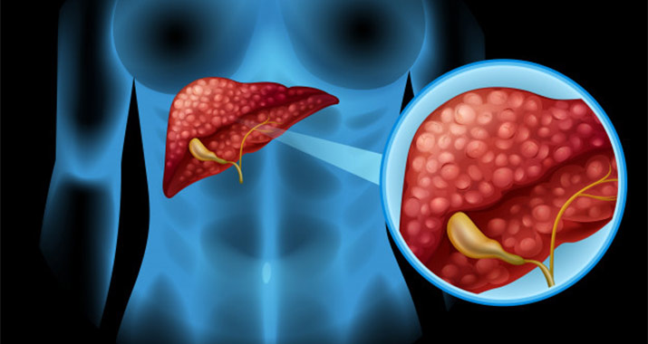 What are the Symptoms of Liver Cancer?
