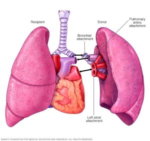 trasplante de pulmón