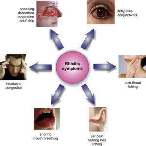 symptômes de la rhinite allergique