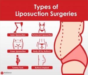 types of liposuction