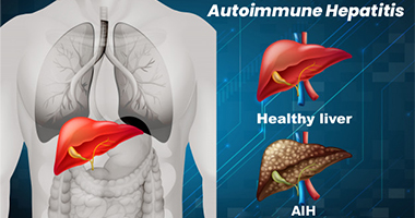 Hepatitis autoinmune (HAI)