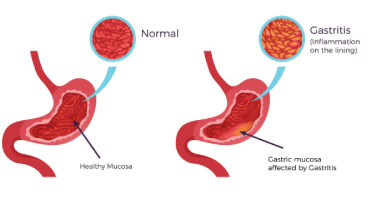 Tumeur stromale gastro-intestinale (GIST)