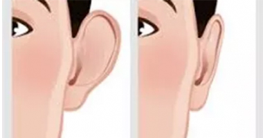 Otoplasty Ear-Shape-Correction-Surgery