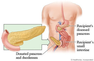 Pankreas-Only-Transplantation