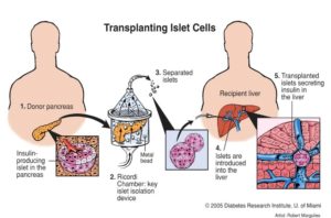 Transplantation von Inselzellen der Bauchspeicheldrüse