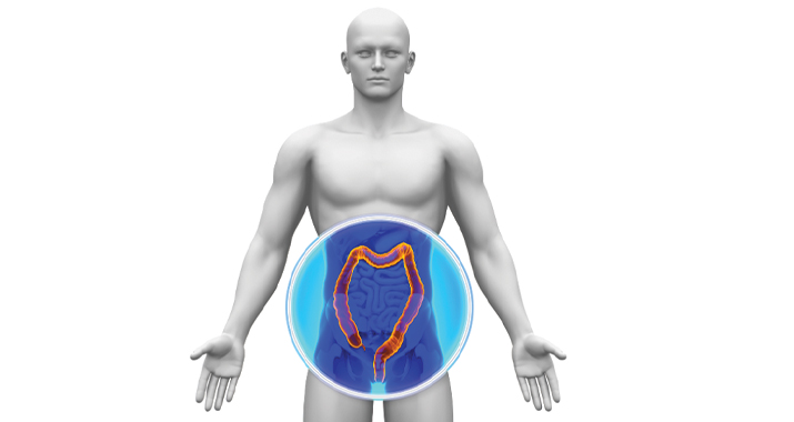 What is Colon Cancer?
