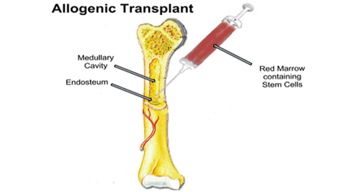 Side Effects Of Bone Marrow Transplant