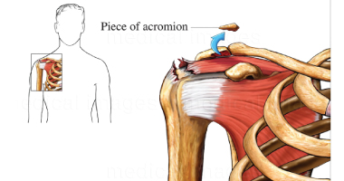 Acromioplasty