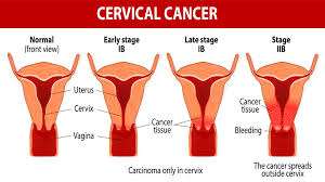 Le cancer du col de l'utérus peut-il être transmis sexuellement ?