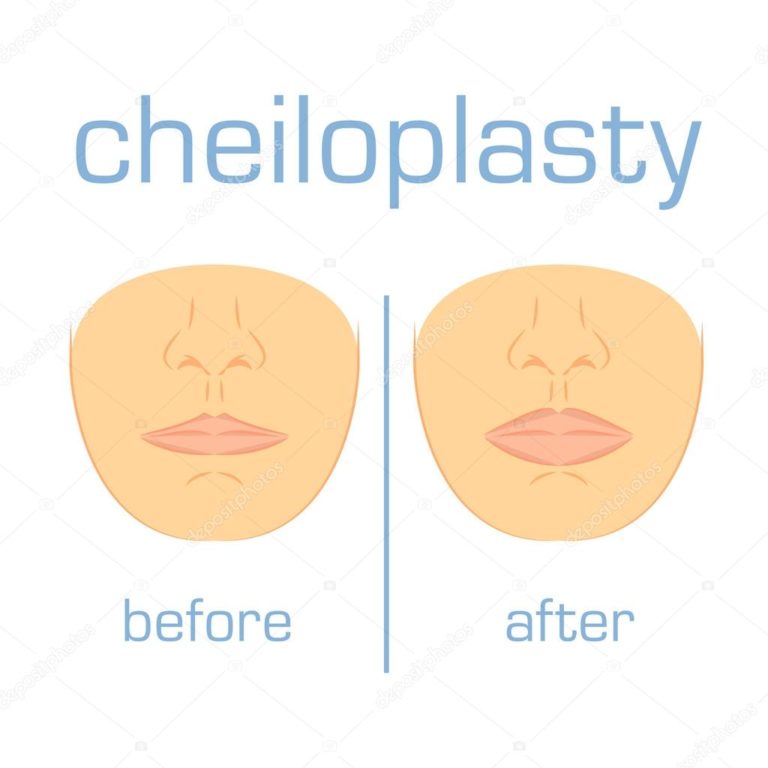 Cheiloplasty