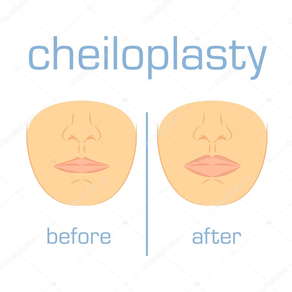 Cheiloplasty