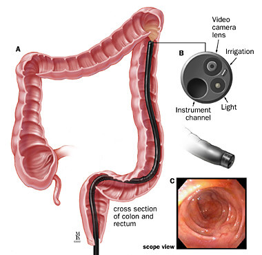 What Is A Flexible Sigmoidoscopy? Procedure, Cost, After Effects
