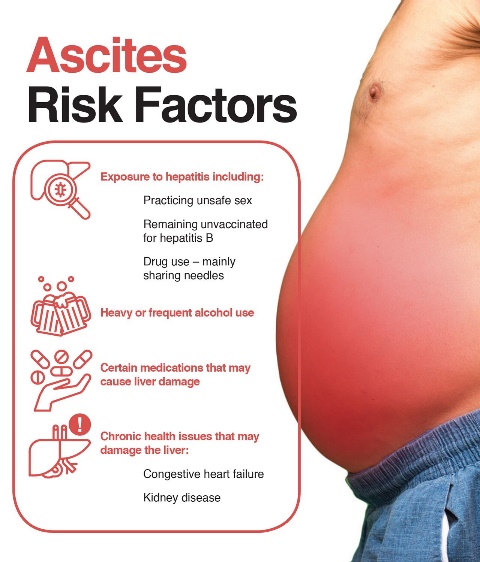 risk factors of ascites