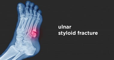 Ulnar Styloid Fracture