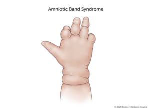 Amniotic band syndrome