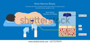 Bone Marrow Aspiration or Biopsy