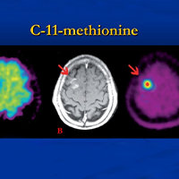 C-11 Choline PET scan